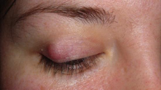 Eyelid redness, Skin irritation, Skin rash and Skin ...